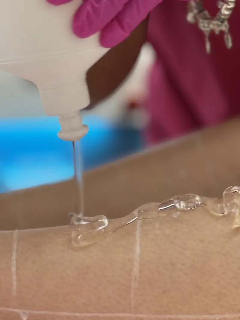 Gel de răcire turnat pe picior pentru protejarea pielii în timpul epilării cu laser