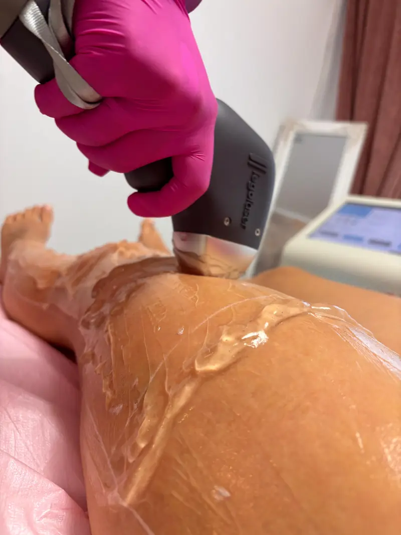 Ședință de epilare definitivă cu laser pe picioare, cu manipulul ERIDE Smart Dual în lucru